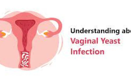 Yeast Infection (vaginal)