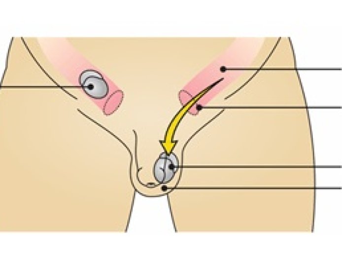 Undescended Testicle