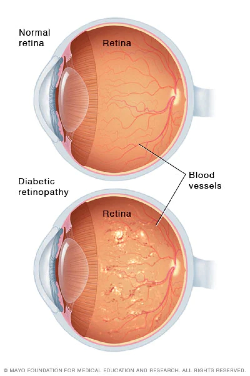 Diabetic Retinopathy