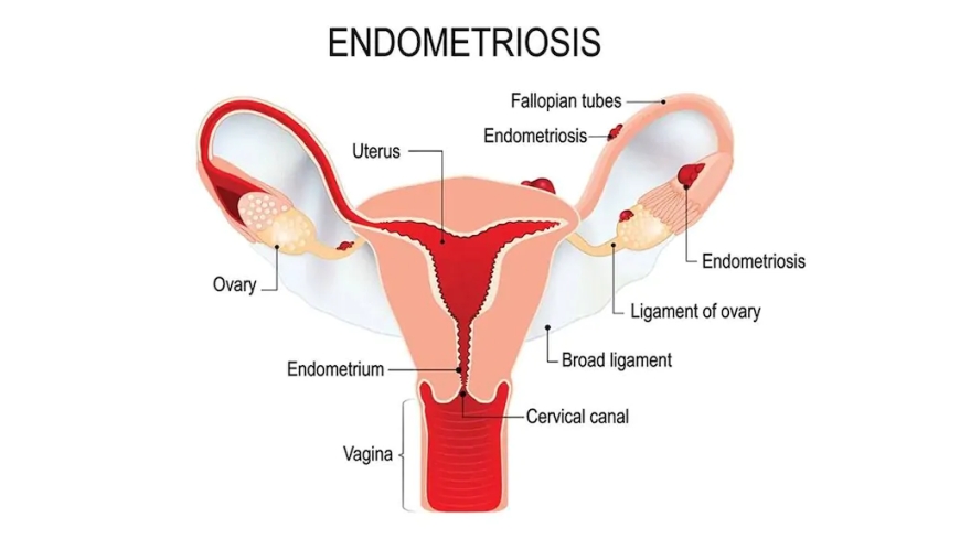 Hormone therapy for endometriosis