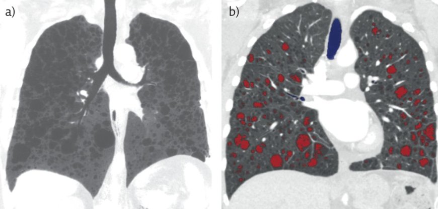 Cystic lung disease