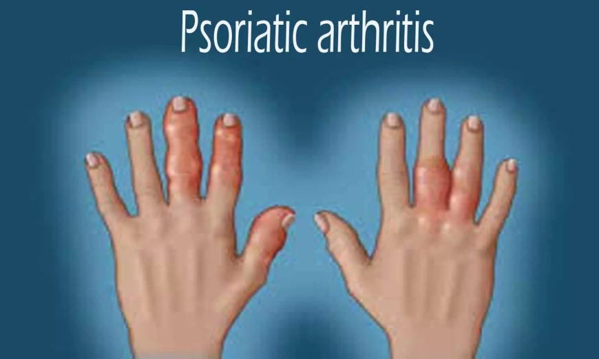 Arthritis, Psoriatic