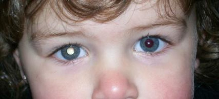 Retinoblastoma