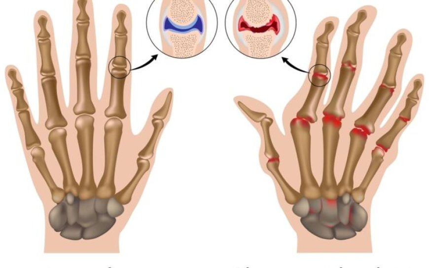 Rheumatoid Arthritis