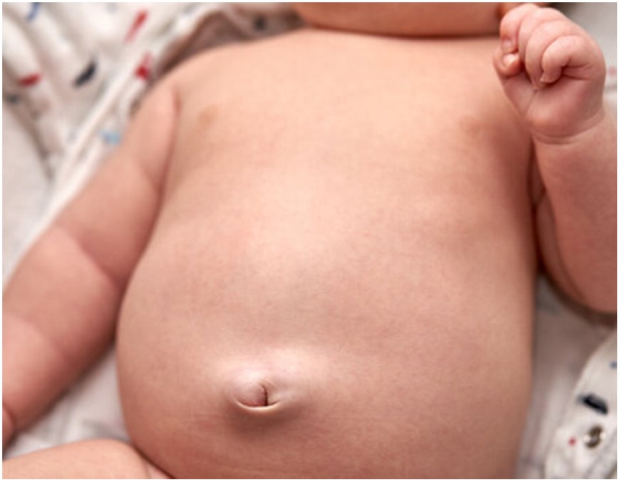 Umblical hernia in children