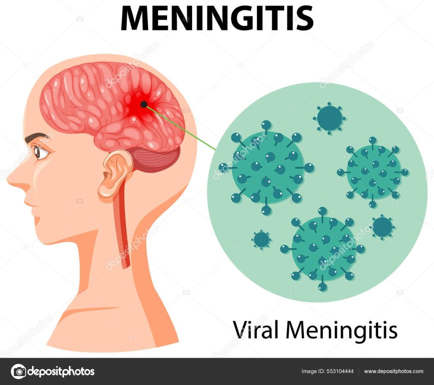 Viral meningitis