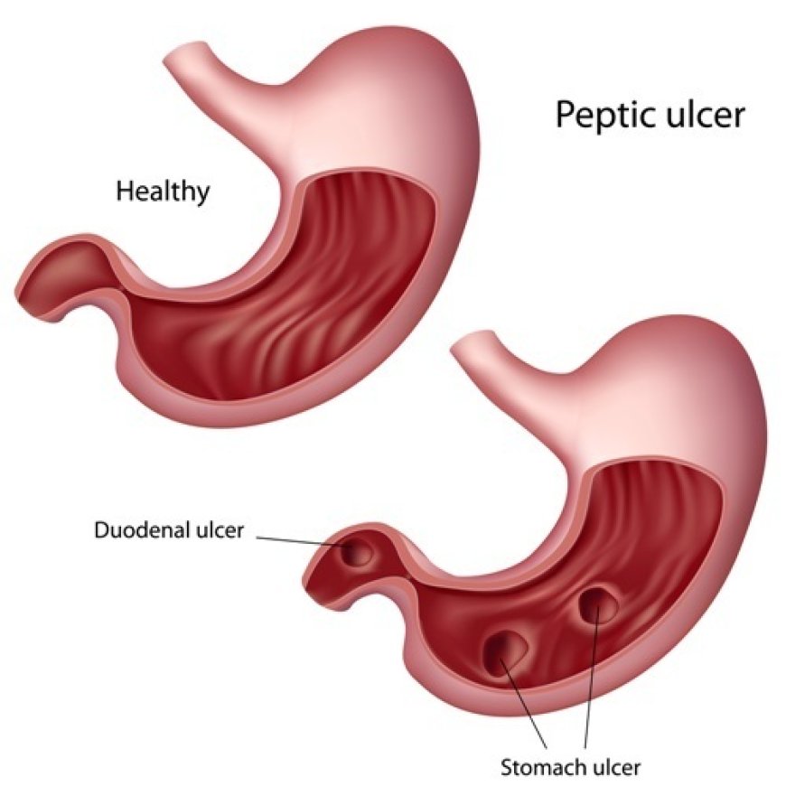 Ulcer - Peptic