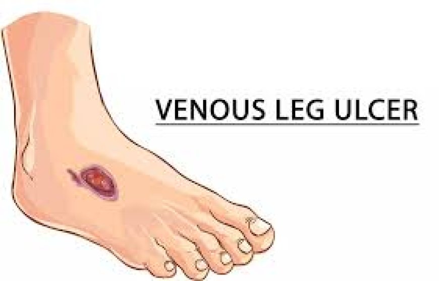 Venous skin ulcers