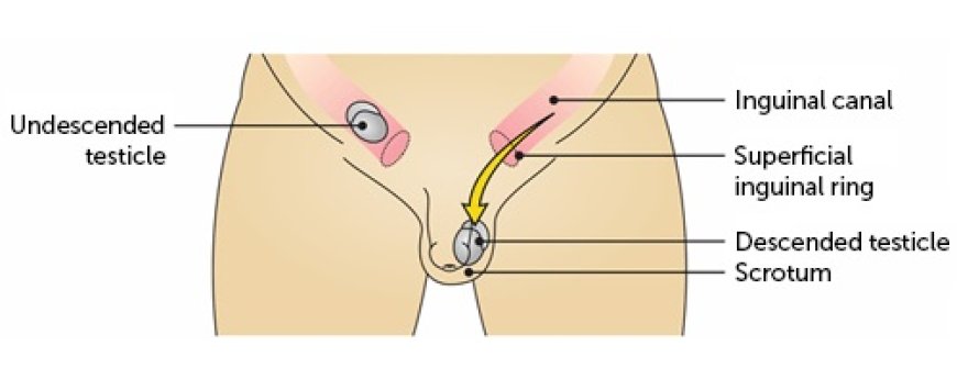 Undescended Testicle