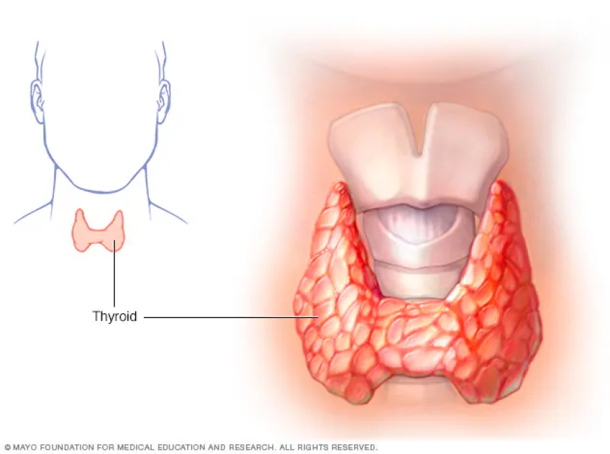 Underactive Thyroid (Hypothyroidism)